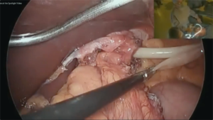 Hiatal_Hernia_Surgery_1