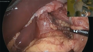 Hiatal_Hernia_Surgery_2