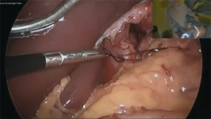 Hiatal_Hernia_Surgery_3