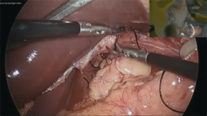 Hiatal_Hernia_Surgery_4