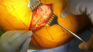 Hip_Arthroplasty_3