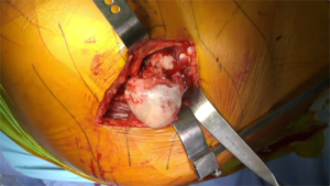 Hip_Arthroplasty_4