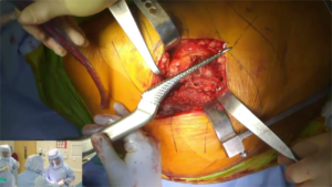 Hip_Arthroplasty_5