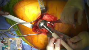 Hip_Arthroplasty_6