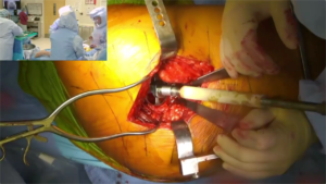 Hip_Arthroplasty_7