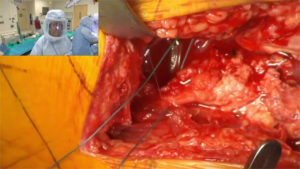 Hip_Arthroplasty_8
