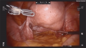 Laparoscopic_Hysterectomy_1-min
