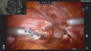 Laparoscopic_Hysterectomy_4-min