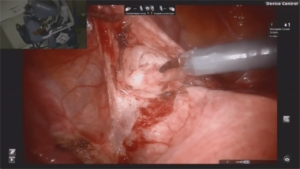 Laparoscopic_Hysterectomy_5-min