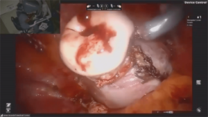 Laparoscopic_Hysterectomy_6-min