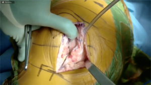 Partial_Knee_2-min