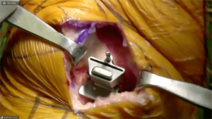 Partial_Knee_4-min