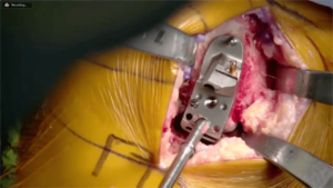 Partial_Knee_6-min