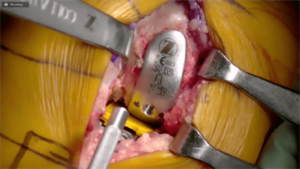 Partial_Knee_7-min