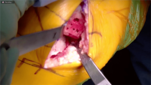 Partial_Knee_8-min