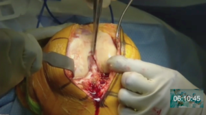 knee-surgery-2020-3