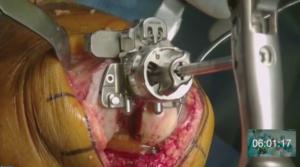knee-surgery-2020-4