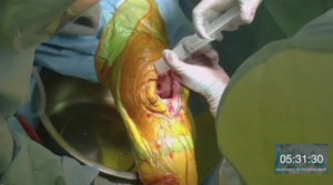 knee-surgery-2020-5