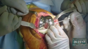 knee-surgery-2020-6