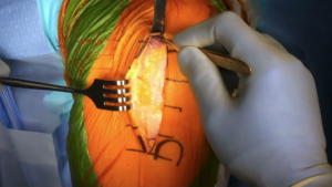 narvaez_sugery1