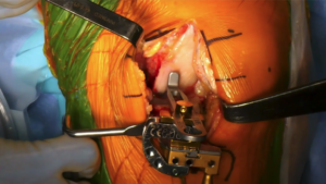 narvaez_surgery
