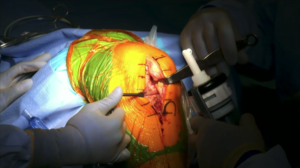 narvaez_surgery3