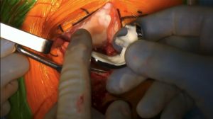 narvaez_surgery4